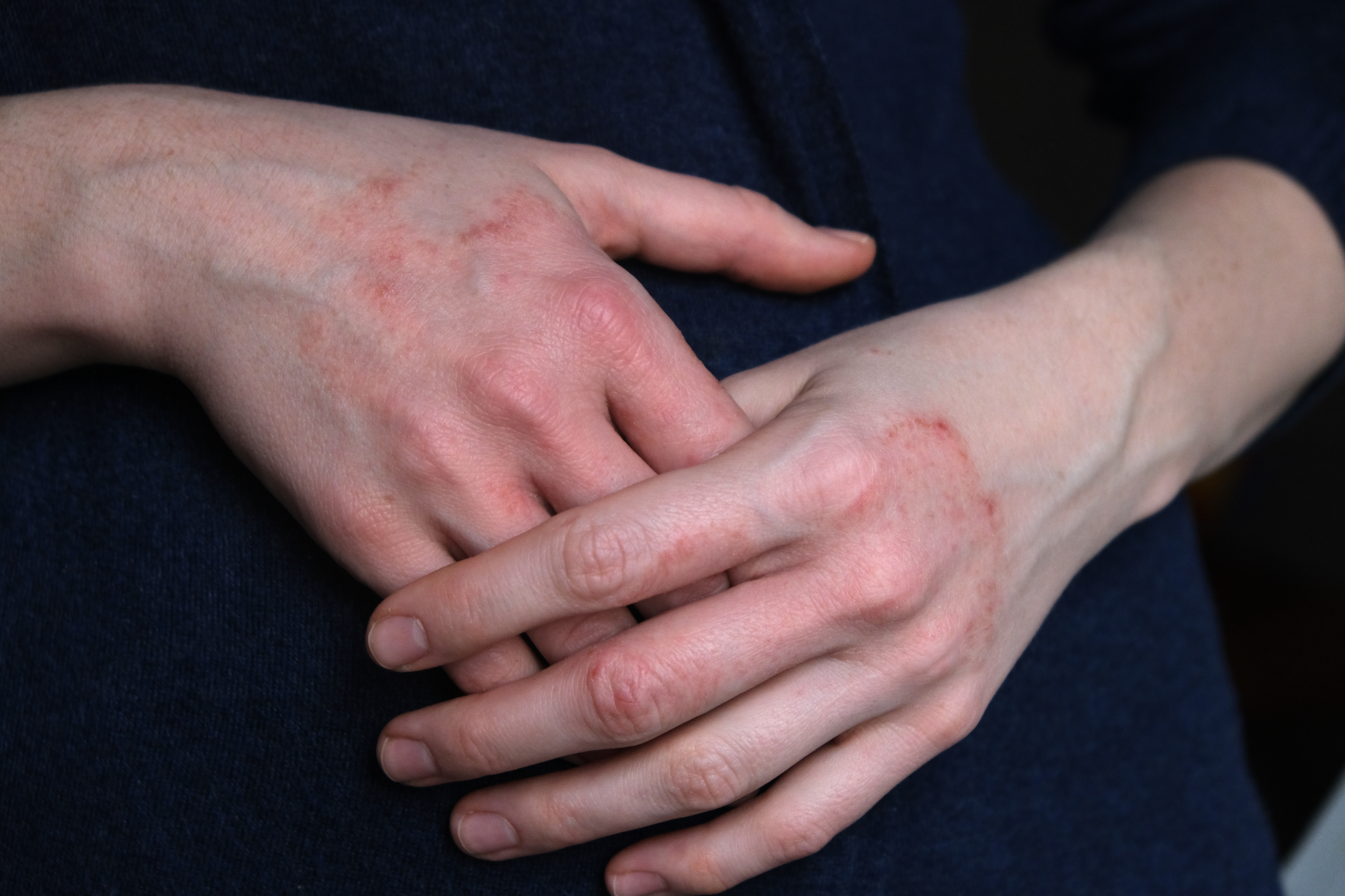 eczema dry hands